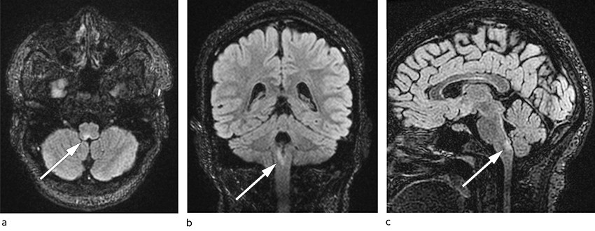 Figur 1 Representative MR-bilder av lesjon i area postrema: T2-FLAIR i henholdsvis aksial- (a), koronar- (b) og sagittalplan&hellip;