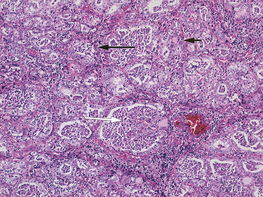 Figure 2 Histological section of post-operative tissue specimen from right thyroid lobe. The image shows extensive changes&hellip;