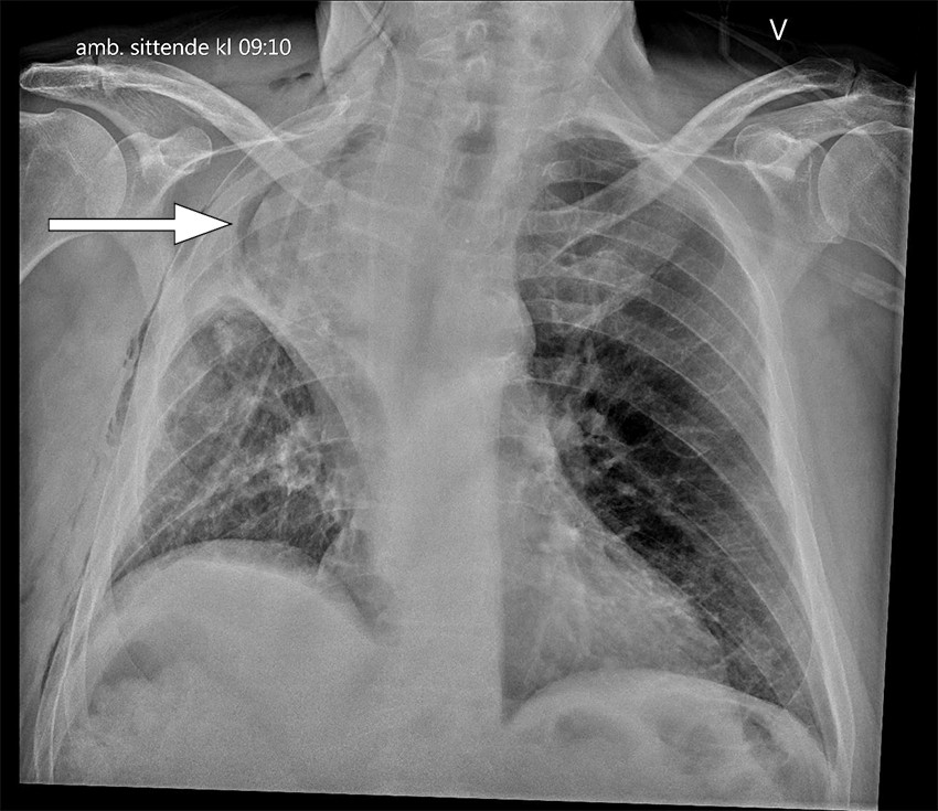 Figur 1 R&oslash;ntgen toraks frontbilde tatt sittende i seng f&oslash;rste postoperative dag etter prim&aelig;roperasjonen. Bildet viser&hellip;