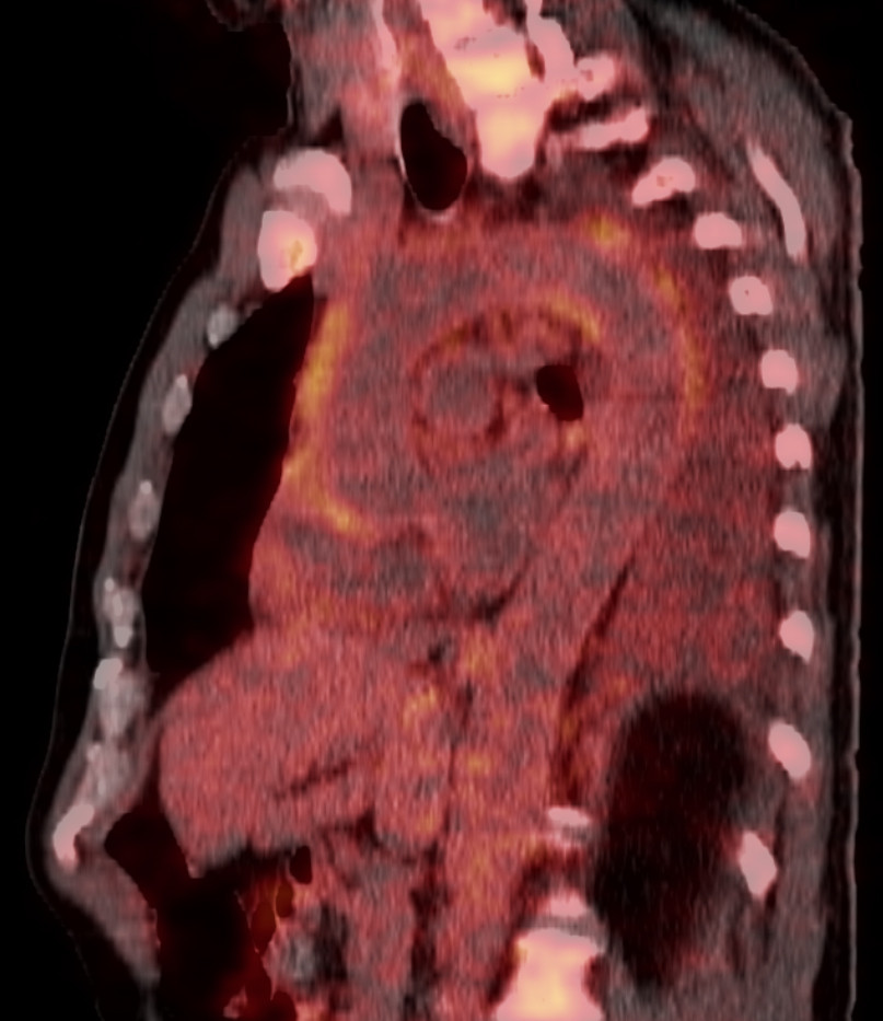 Figur 1 PET-unders&oslash;kelse med&nbsp;&sup1;⁸F-fluordeoksyglukose kombinert med CT (&sup1;⁸F-FDG-PET-CT) viser torakalaorta (sagittalt snitt)&hellip;