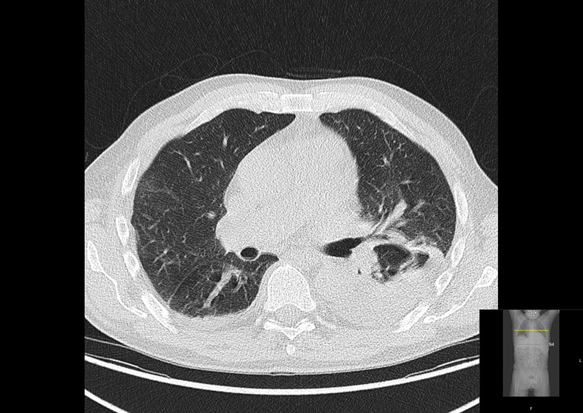 Figur 2 CT-delen (aksialt snitt) av PET-CT-unders&oslash;kelsen i midtre del av lungene viser et infiltrat i venstre underlapp og&hellip;