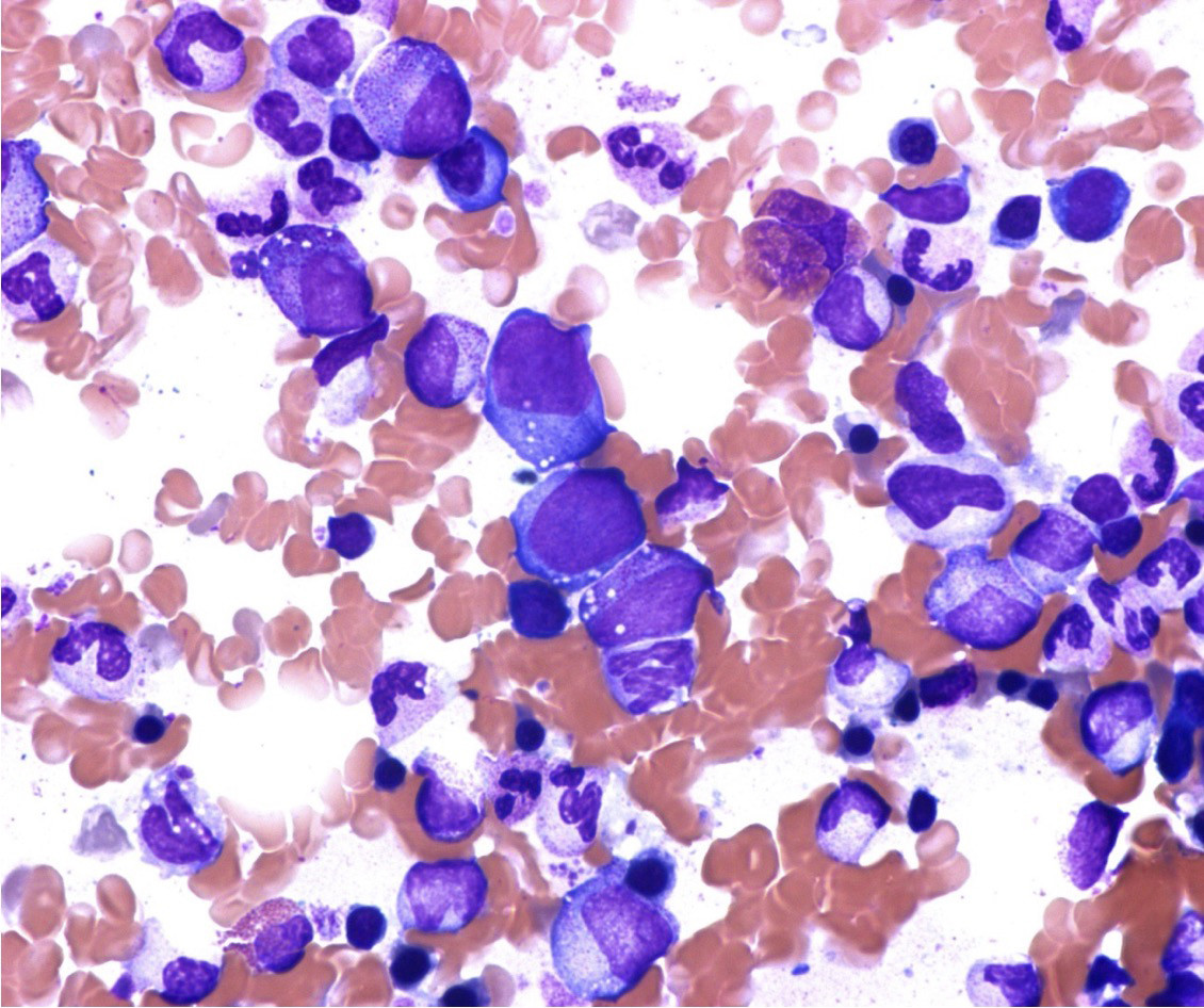 Figure 3 Vacuolation in erythroid and myeloid precursor cells. Photo: Signe Spetalen, Oslo University Hospital.