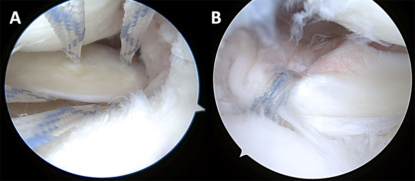 Figur 4 Artroskopi. a) Medial rotruptur med sutur i bakre horn av menisken. b) Suturene trukket ned i borekanal i tibia&hellip;