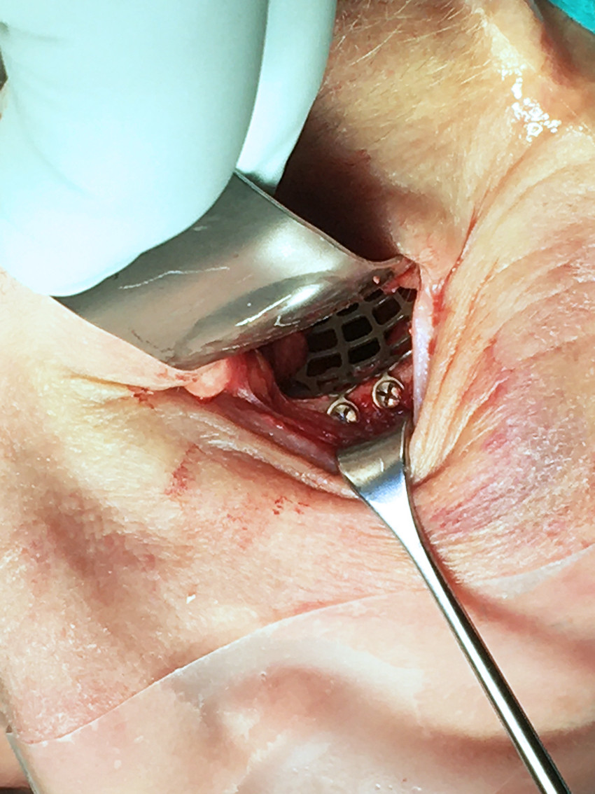 Figure 4 Intraoperative photograph of left orbital floor fracture reconstructed with a patient-specific titanium&hellip;