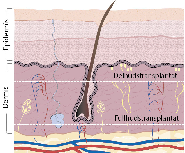 Figur 2 Hudtransplantater inndeles i fullhuds- og delhudstransplantater basert p&aring; hvor tykt lag av huden som transplanteres&hellip;