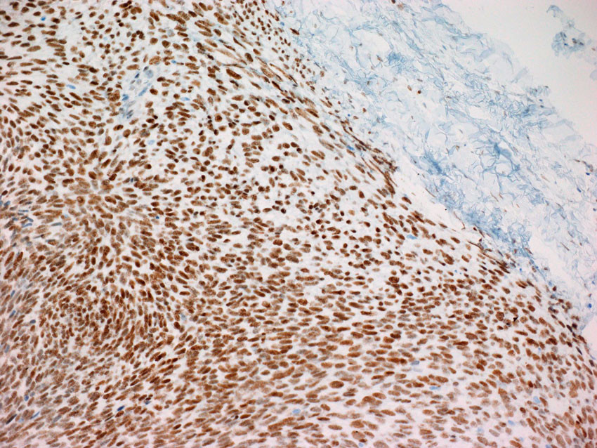 Figure 5 Cell-rich, spindle cell tumour tissue with immunohistochemical analysis with intense nuclear staining with anti&hellip;