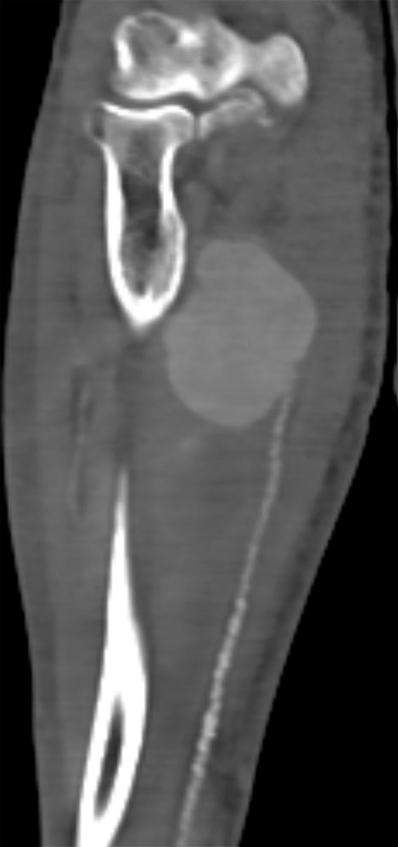 Figur 1 CT-angiografi preoperativt viser et aneurisme. Distalt for aneurismet ses en forkalket og stenotisk a. ulnaris.