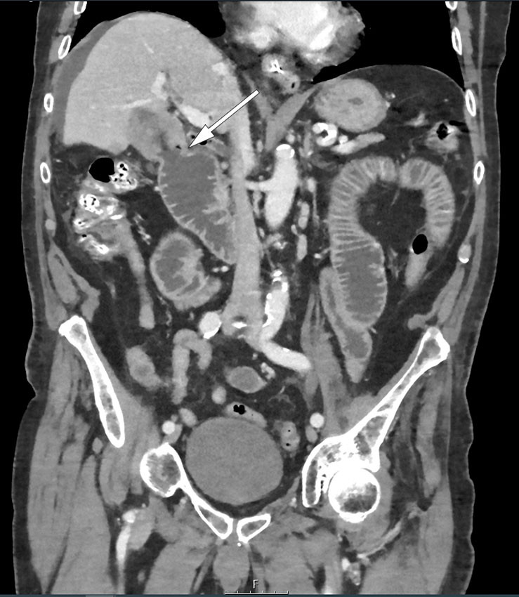 Figur 2 CT, koronalt snitt. Pilen viser fistel mellom patologisk veggfortykket gallebl&aelig;re og duodenum. Duodenum og jejunum&hellip;