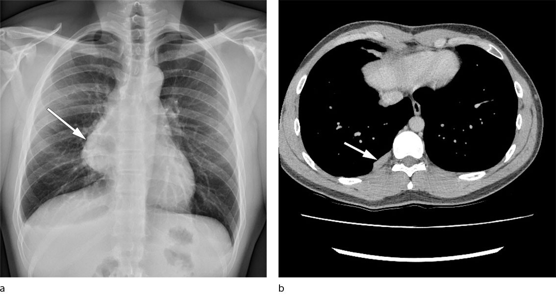 Figur 1 Bildediagnostikk. a) R&oslash;ntgen toraks med funn av mediastinal oppfylning. b) CT toraks med pleurale metastaser to &aring;r&hellip;