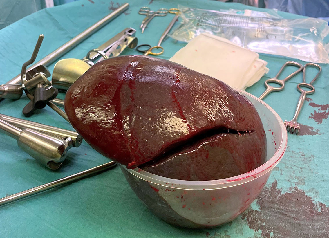 Figure 4 Spleen specimen weighing 1,609&nbsp;g (normal 120&ndash;200&nbsp;g) and measuring 23 &times; 18 &times; 8&nbsp;cm (normal < 12&nbsp;cm in length).