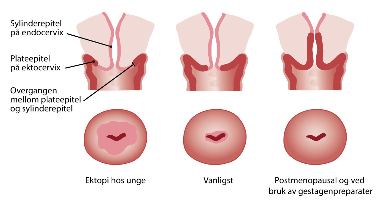 Figur 1 Skjematisk fremstilling av normalvarianter av overgangen mellom plate- og sylinderepitel. (&Oslash;verst: lengdesnitt&hellip;