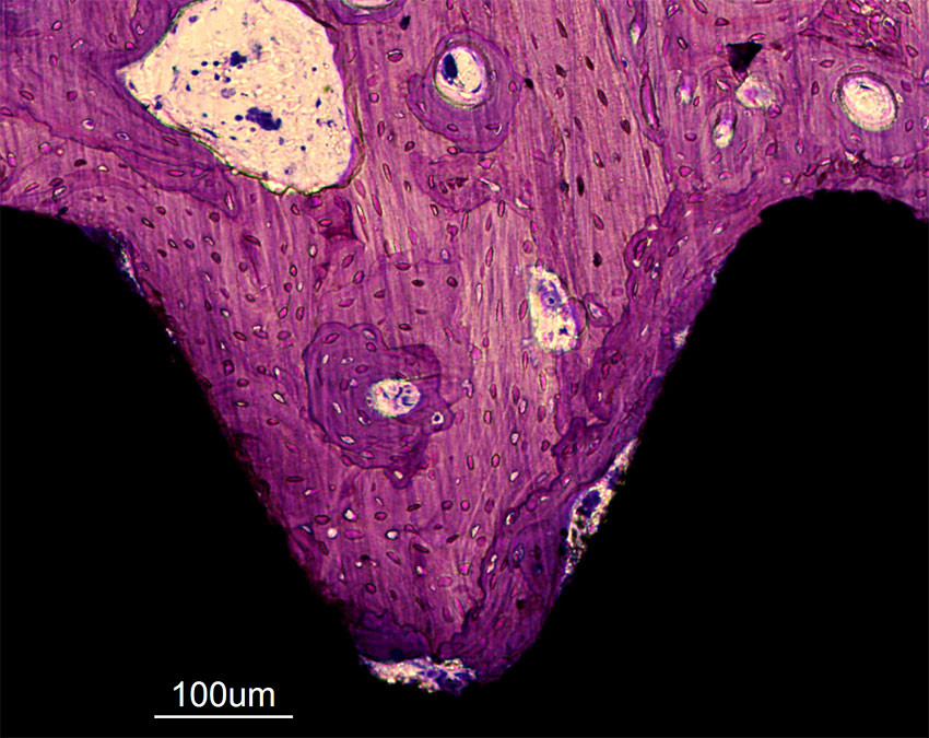 Figur 1 Osseointegrert titanskrue. Beinvev i lilla, implantat i svart. Intimkontakt mellom bein og implantat sees langs&hellip;