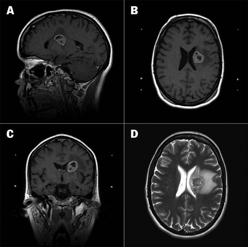 Figure 1 a) Sagittal brain MRI with contrast at the time of gamma knife radiosurgery. b) Axial brain MRI with contrast at&hellip;