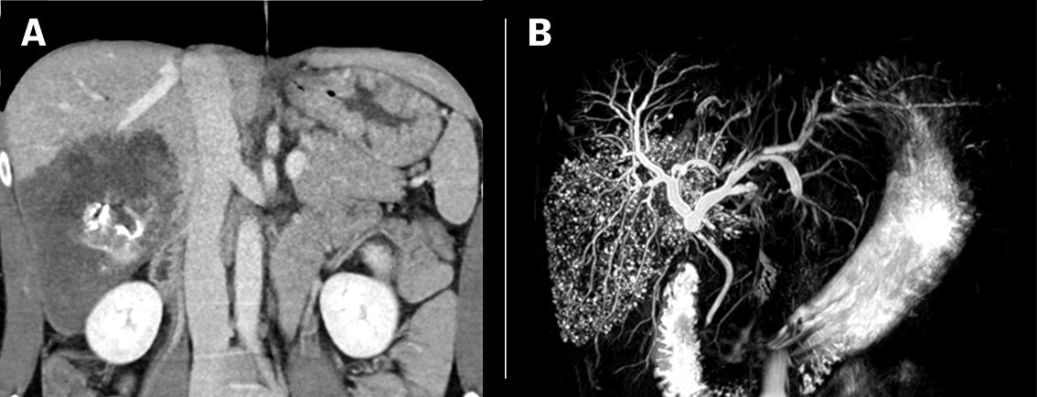 Figur 1 a) Pasient med alveol&aelig;r ekinokokkose (pasient 1). CT med kontrastv&aelig;ske i ven&oslash;s fase med koronal rekonstruksjon viser&hellip;