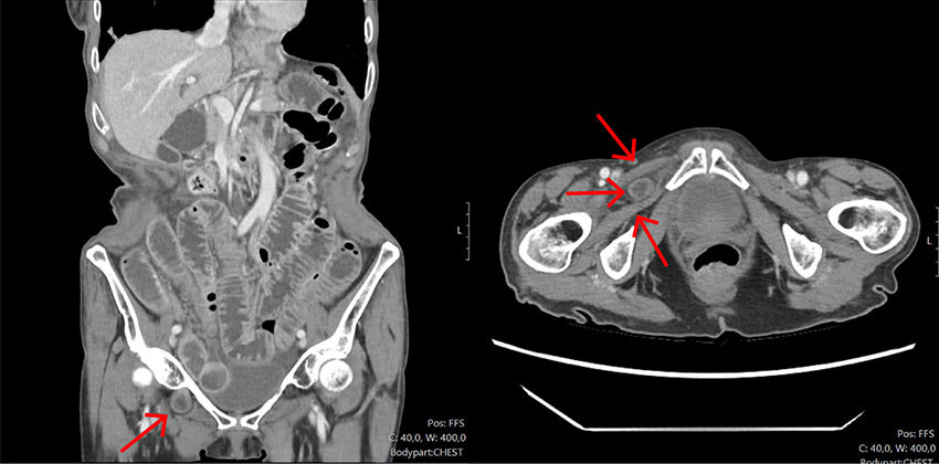 Figure 1 CT of the abdomen with intravenous contrast (axial and coronal planes) on day four after the initial admission&hellip;