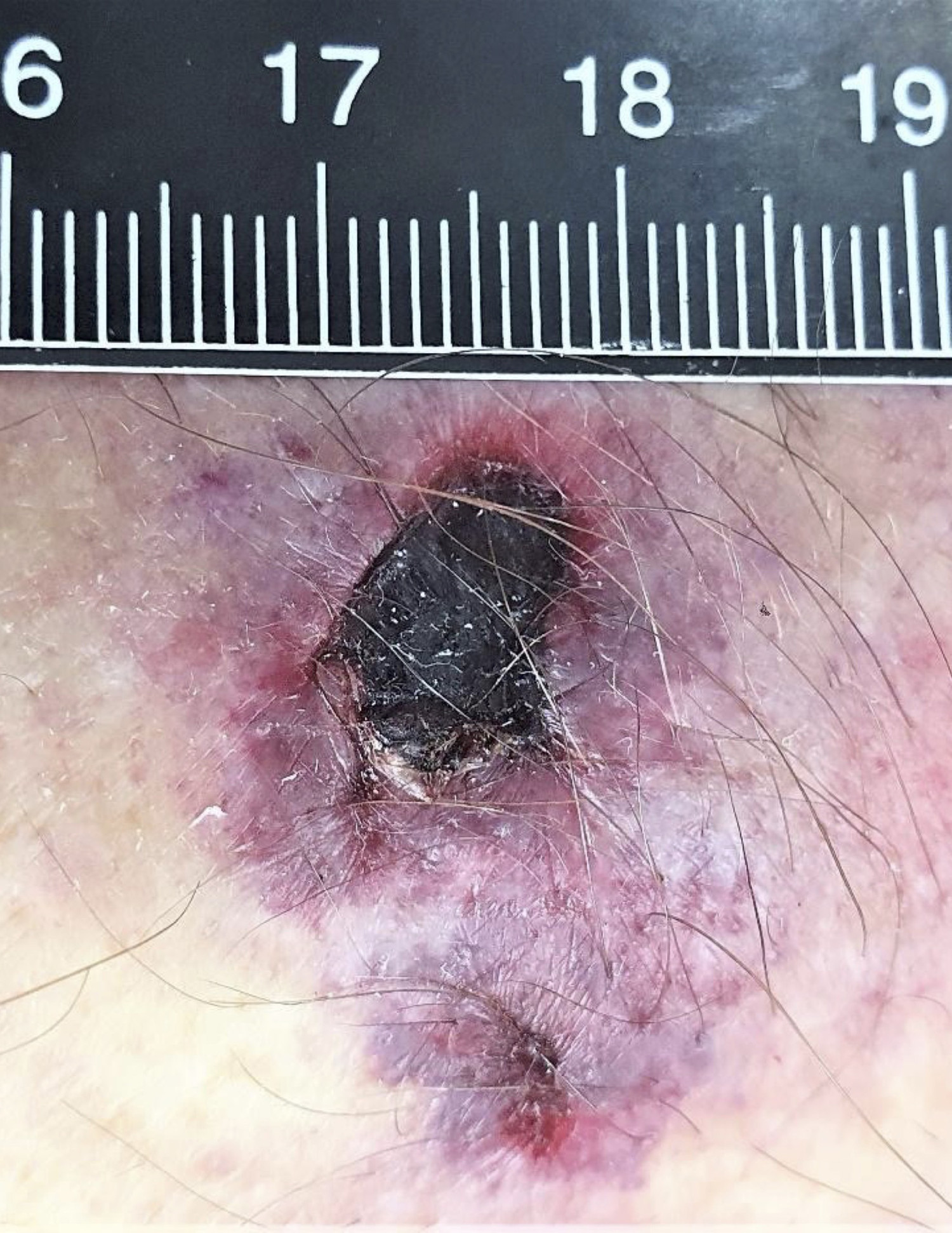 Figur 1 S&aring;ret i huden p&aring; h&oslash;yre underarm med t&oslash;rr skorpe og r&oslash;de s&aring;rkanter.
