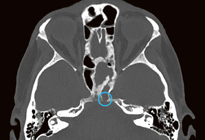 Figure 3 CT of the sinuses showed an opacified, sclerotic left sphenoid sinus consistent with chronic inflammation,&hellip;