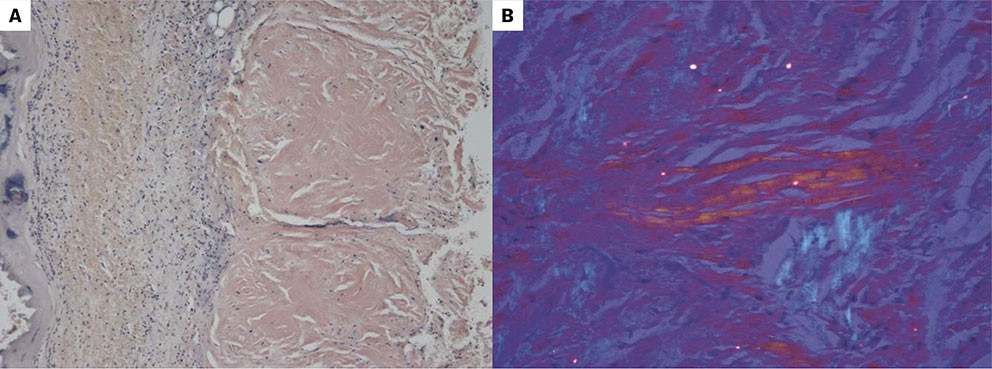 Figure 2 a) Congo red&ndash;stained tumour section (20&times; magnification) showing myocardium with condensed eosinophilic cytoplasmic&hellip;