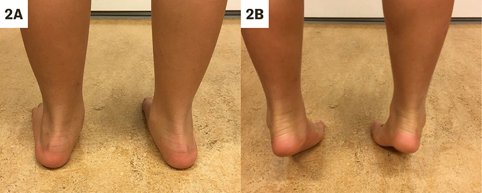 Figur 2 Barn med fleksibel plattfot demonstrer hvordan lengdebuene formes ved t&aring;gange (heel-raise), samtidig som h&aelig;lene&hellip;