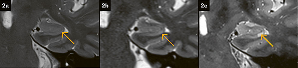 Figure 2 Hyperintense punctate lesion in the left hippocampus in transient global amnesia (arrow). T2-weighted sequences in&hellip;