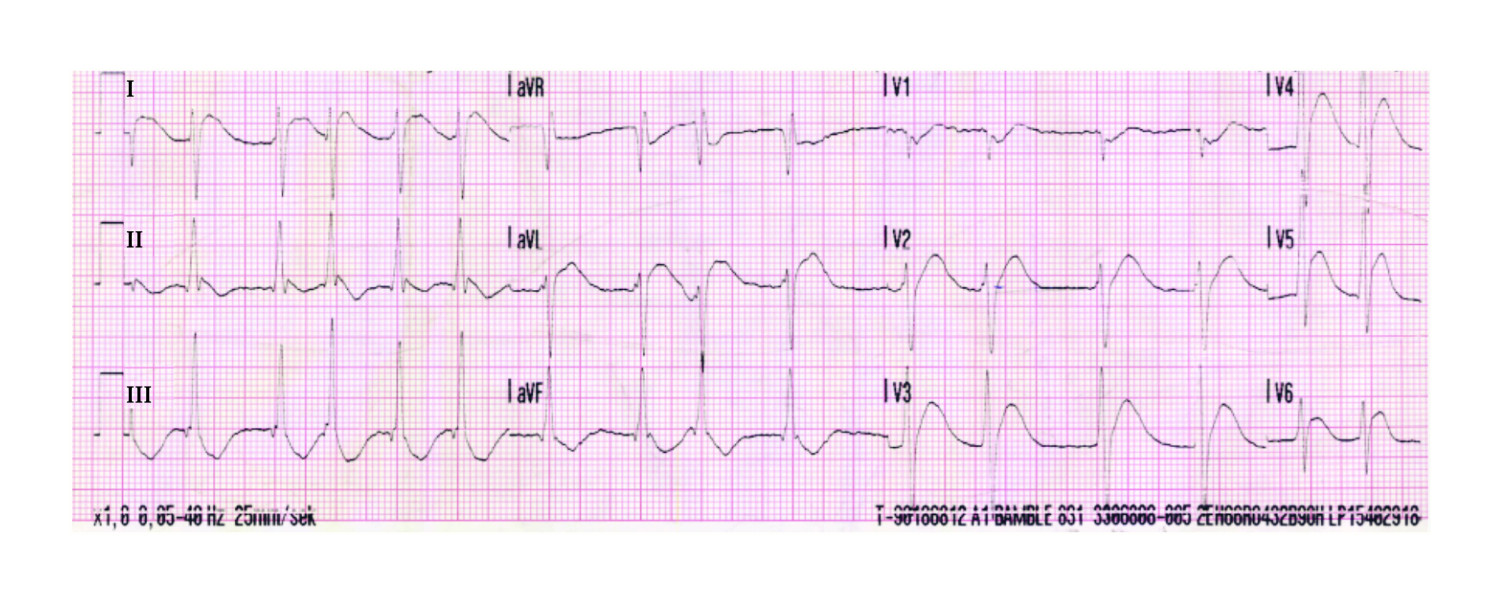 Figure 1 ECG recorded in the ambulance immediately after return of spontaneous circulation showed atrial fibrillation with&hellip;