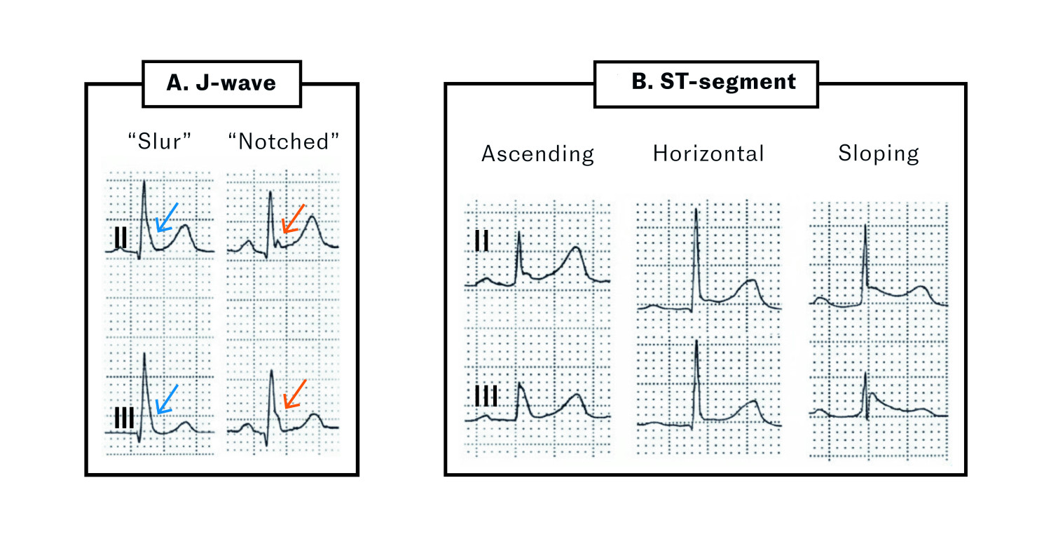 Figure 5 Different manifestations of early repolarisation. Modified from Antzelevitch et al. (3). a) The J wave may be well&hellip;