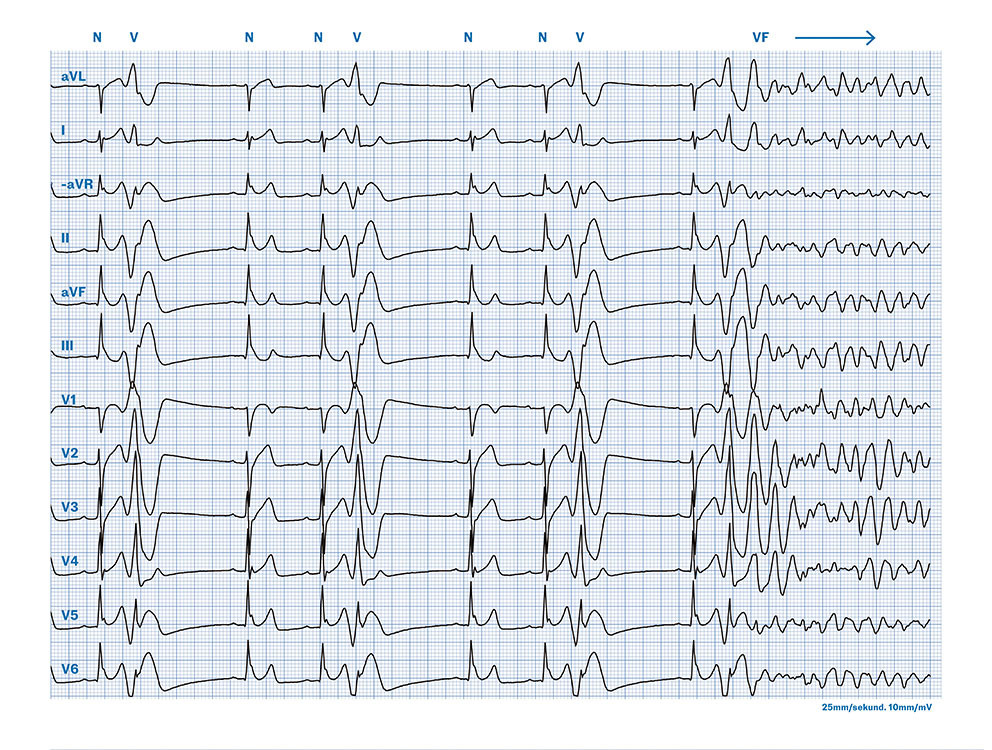Figure 2 ECG immediately before cardiac arrest (Cabrera format, paper speed 25&nbsp;mm/s). Sinus rhythm, rate 65 beats per minute&hellip;