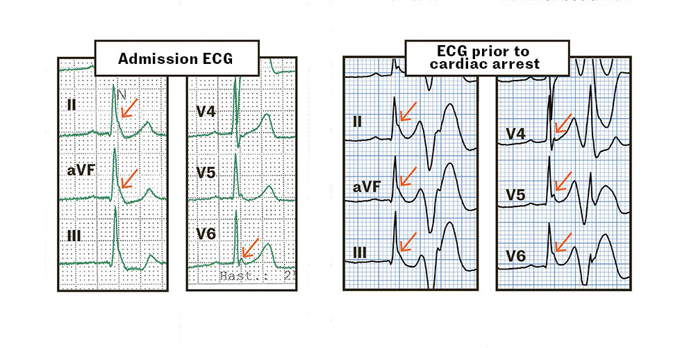 Figure 3&nbsp;J waves indicated by arrows. The left panel shows the inferior and lateral leads from the admission ECG, while the&hellip;