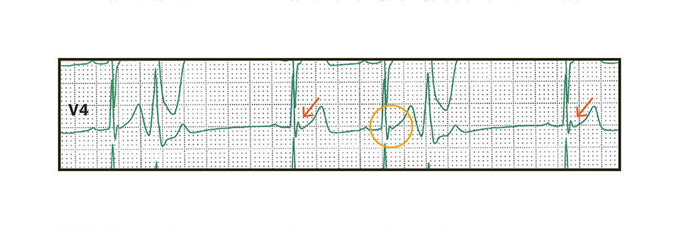 Figure 4 Rhythm strip from lead V4. QRS complexes preceded by a post-extrasystolic pause, and thus a prolonged RR interval,&hellip;