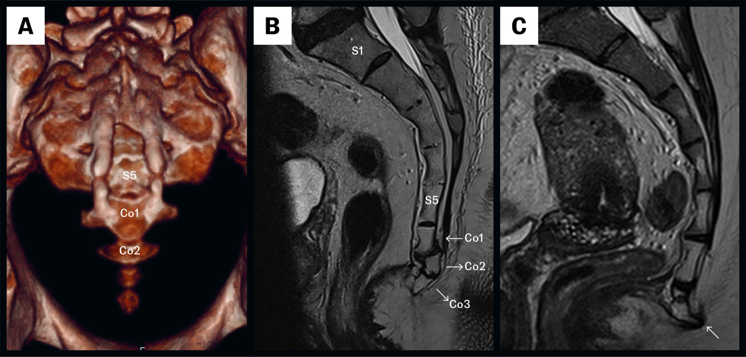 Figur 1 a) Normalfunn med fire koksygeale virvler vist p&aring; CT (frontbilde i 3D-reformat). Sagittal MR av sakrum og coccyx&hellip;