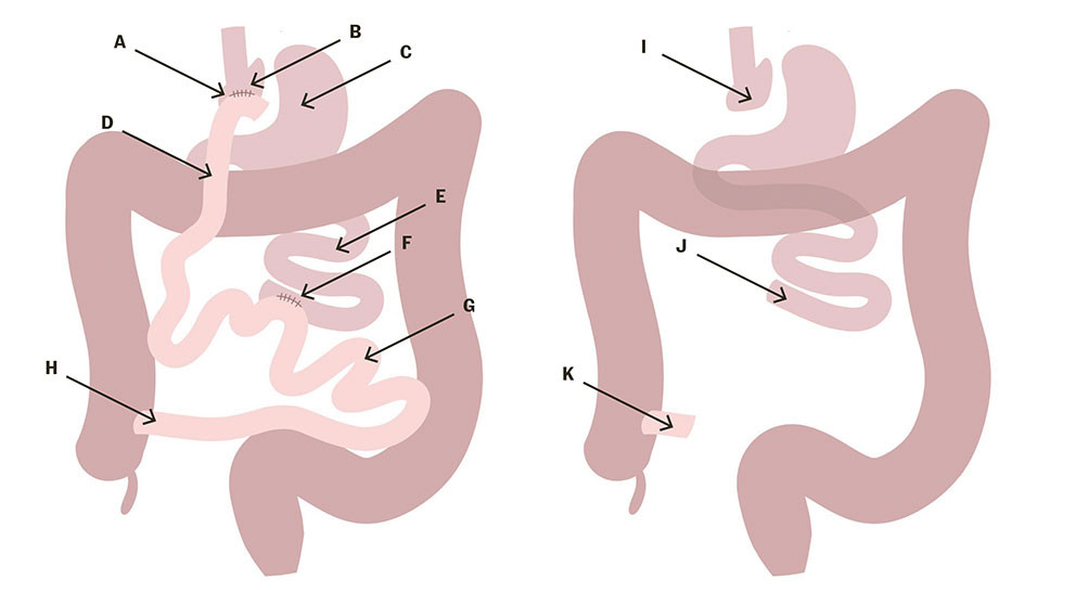 Figur 2 Pasientens anatomi etter Roux-en-Y-gastrisk bypass (venstre) og anatomi etter akuttoperasjon (h&oslash;yre). a)&hellip;