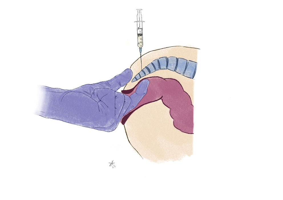 Figure 4 Injection technique with concurrent rectal palpation and index finger as a guide to the position of the coccyx&hellip;