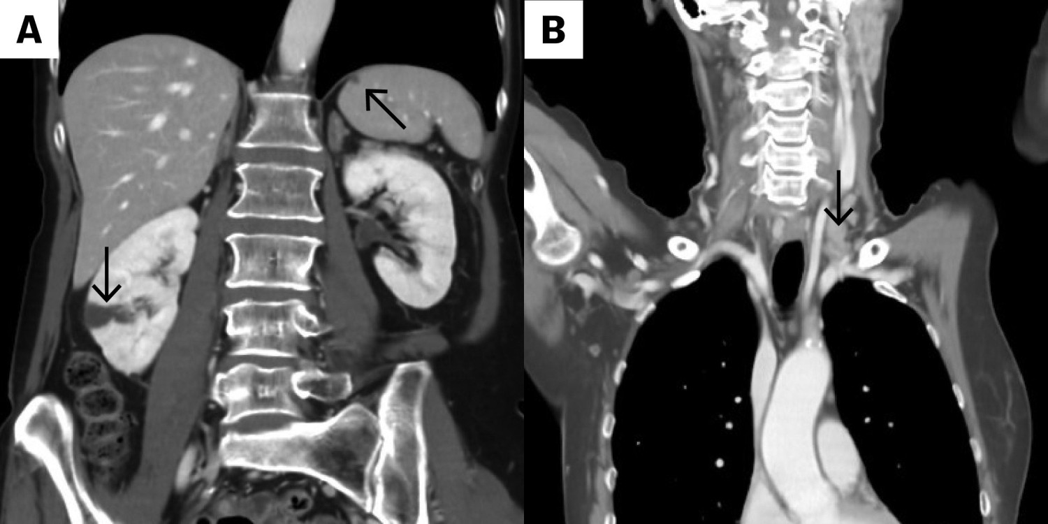 Figur 1 CT av toraks, abdomen og bekken som viser a) emboliske infarkter i milt og nyre, samt b) supraklavikul&aelig;r lymfeknute&hellip;