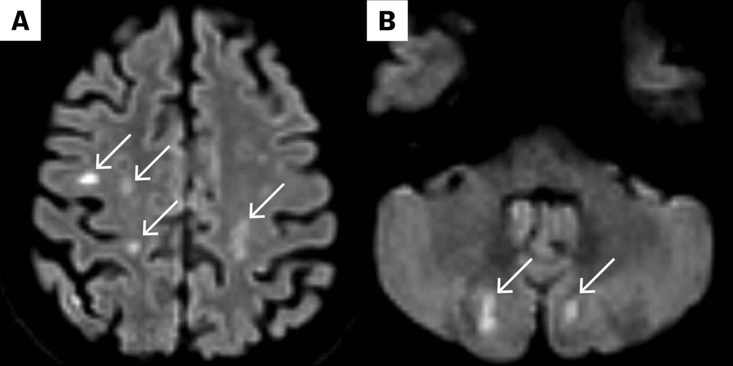 Figur 2 MR caput som viser a) emboliske infarkter i begge cerebrale hemisf&aelig;rer og b) emboliske infarkter i cerebellum&hellip;