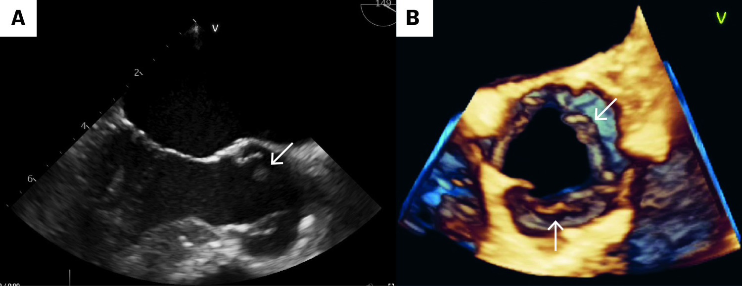 Figur 3 a) 2D-trans&oslash;sofageal ekkokardiografi som viser en vegetasjon p&aring; aortaklaffen. b) 3D-rekonstruksjon som avdekker&hellip;