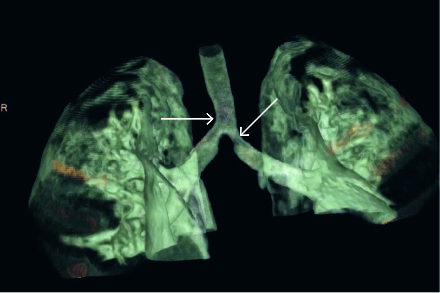 Figure 1 Example of a 4D-CT volume image in the frontal plane. The arrows indicate external compression of the trachea and&hellip;