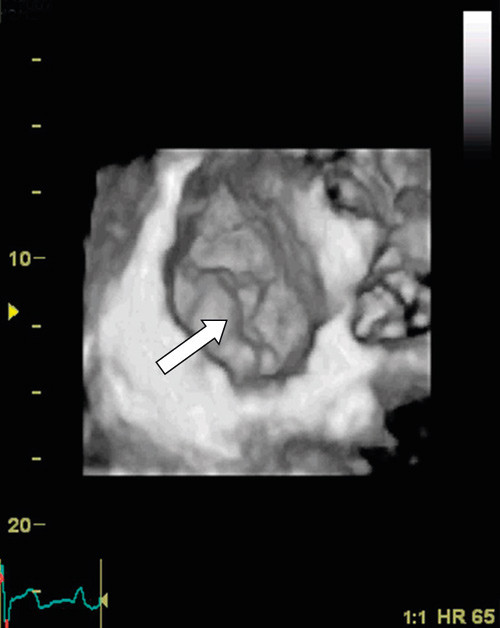 Figure 2  Transthoracic recording of the mitral valve viewed from the left atrium (&laquo;surgeon&rsquo;s view&raquo;). The white arrowhead&hellip;