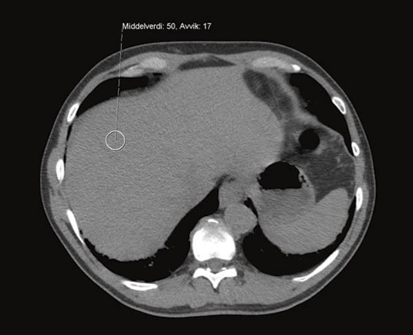Figure 2   CT abdomen without contrast from patient without pathological changes