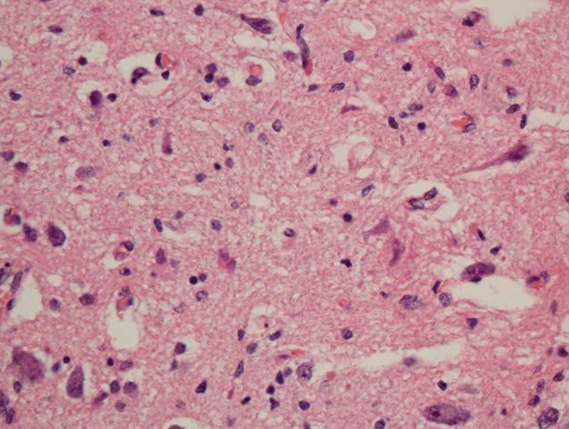 Figure 1  Anterior horn, possible nerve cell loss (subtle) and slight reactive gliosis. Photo David Schei