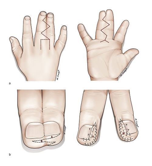 Figure 3  Example of a plasty for separation of syndactyly between the long and ring finger. a) Planning sketch from the&hellip;