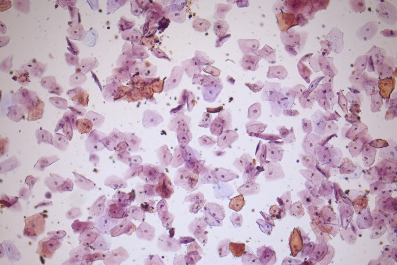 Figur 1  Urinsediment forst&oslash;rret ti ganger viser tallrike epitelceller. Slike celler stammer fra genitalia og er tegn p&aring; at&hellip;