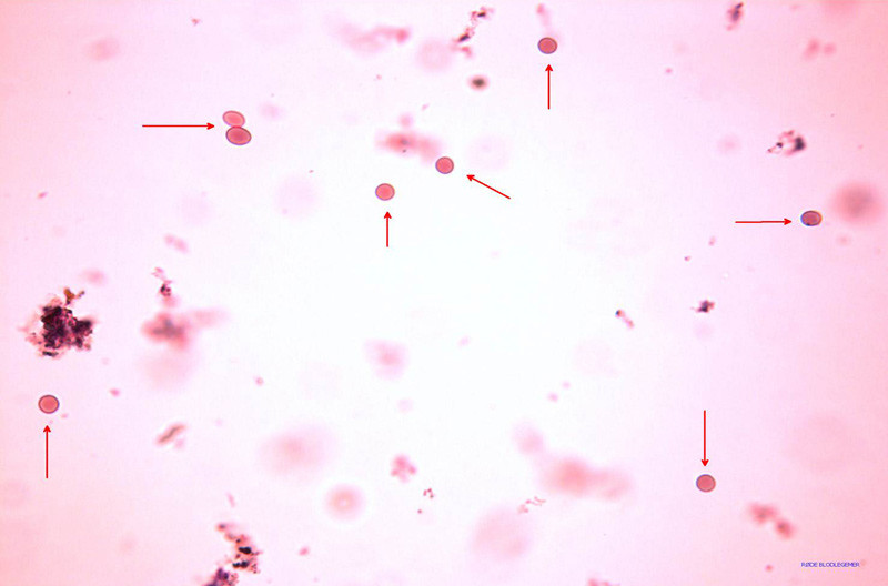 Figure 2  Urine sediment enlarged 40 times shows many intact (isomorphic) erythrocytes. This is a sign of post-glomerular&hellip;