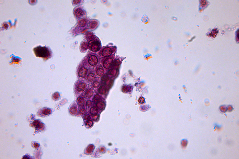 Figur 3  Urinsediment forst&oslash;rret 40 ganger viser rikelig med tubulusepitelceller. Et slikt funn har stor diagnostisk&hellip;
