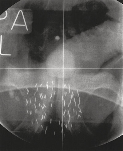 Figure 2  Radiological scan of the pelvis after low-dose-rate brachytherapy. Multiple radioactive iodine seeds are implanted&hellip;