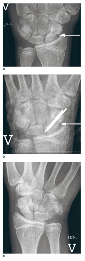 Figure 5  Treatment of scaphoid pseudarthrosis. a) 18-month old scaphoid pseudarthrosis (white arrow) in young man, b)&hellip;