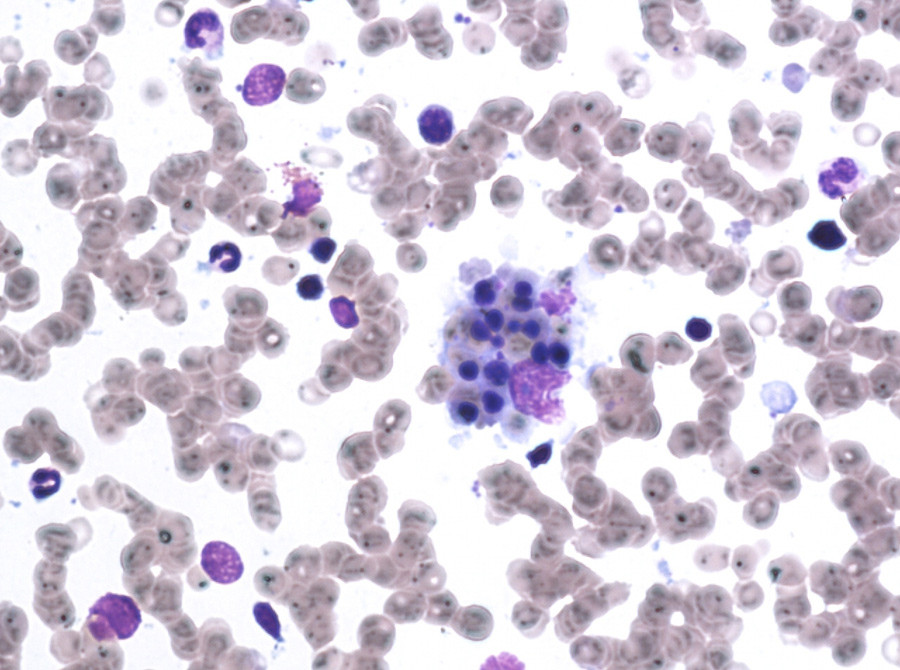 Figure 1  Image of the patient&rsquo;s bone marrow aspirate showing occasional stromal macrophages containing phagocytosed&hellip;