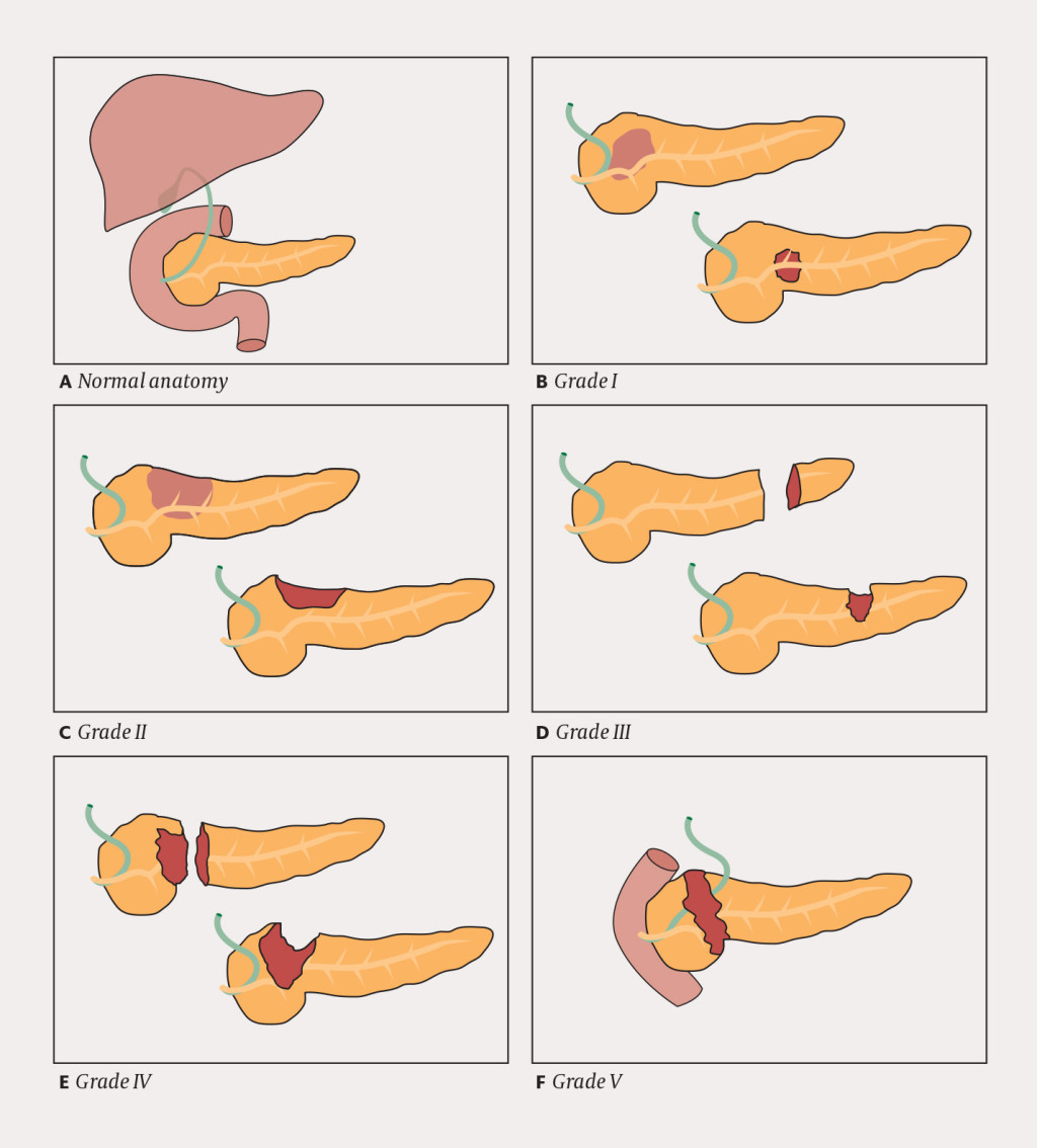 Figure 3 Illustration of injury grade, from the American Association for the Surgery of Trauma (30)