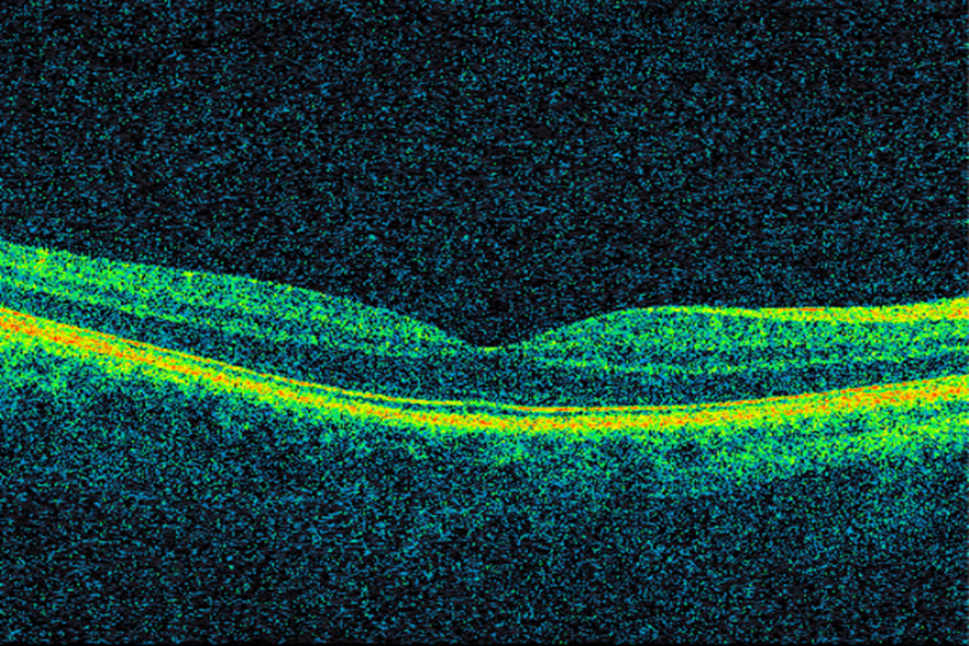 Figur 1 Optisk koherens-tomografi (OCT) som viser normal makula. I midten ses fovea centralis, hvor tettheten av&hellip;