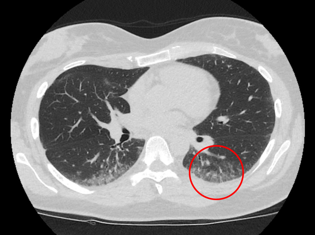 Figure 1 High-resolution thoracic CT shows peripheral subpleural micronodular lung opacities with some ground glass&hellip;