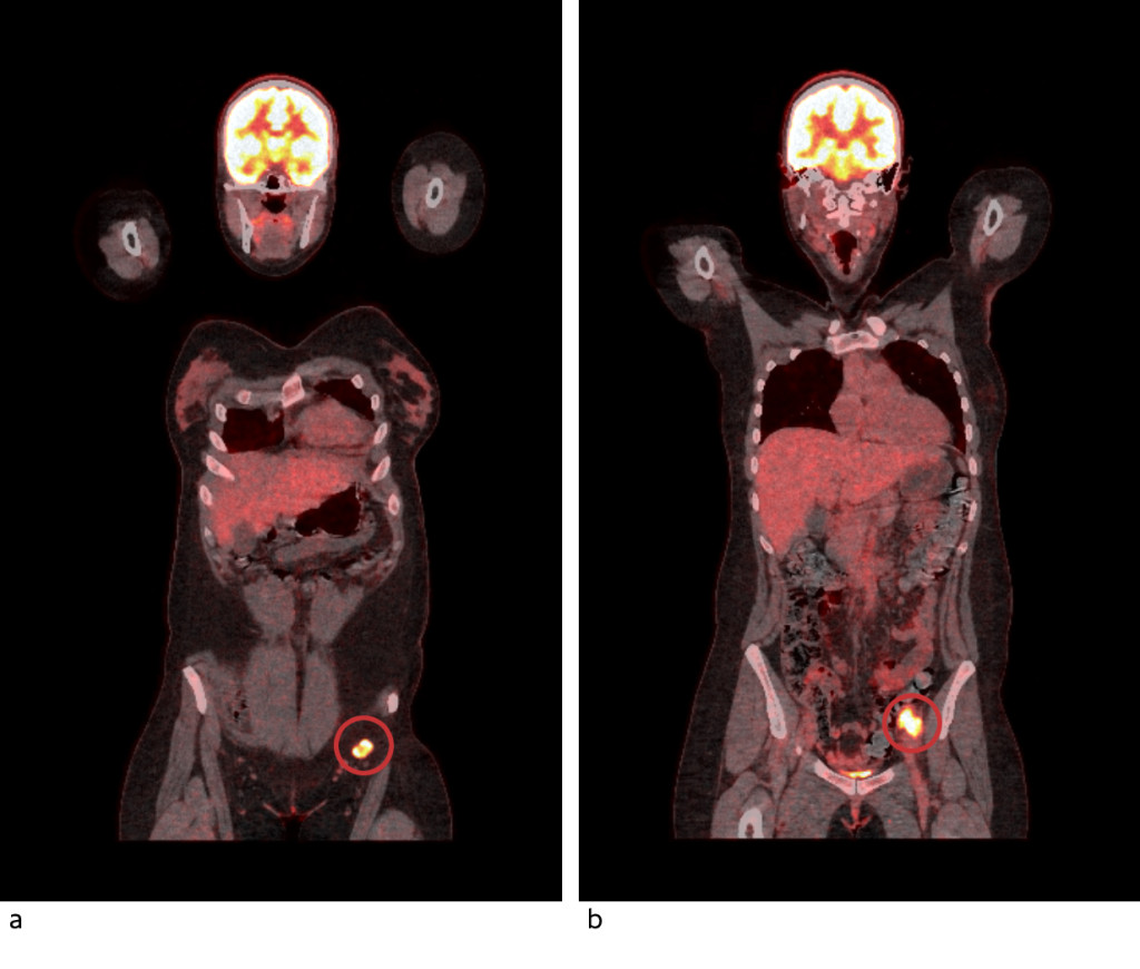 Figure 3 PET-CT shows high uptake of 18F-fluorodeoxyglucose in pathologically enlarged lymph nodes in the left inguinal area&hellip;